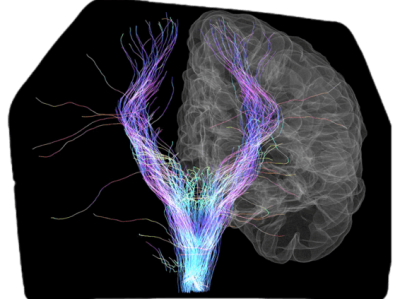 Anotación de neuroimagen